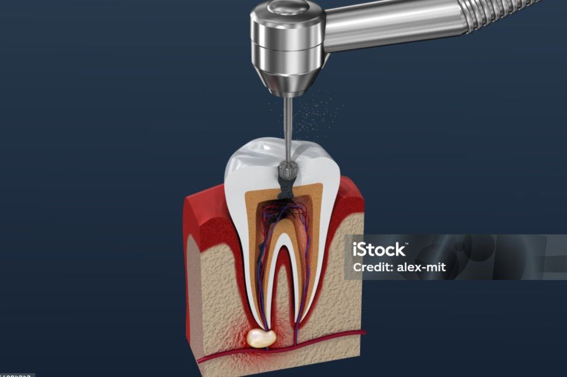 Root Canal Treatment
