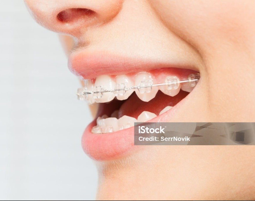 Orthodontics (Braces)