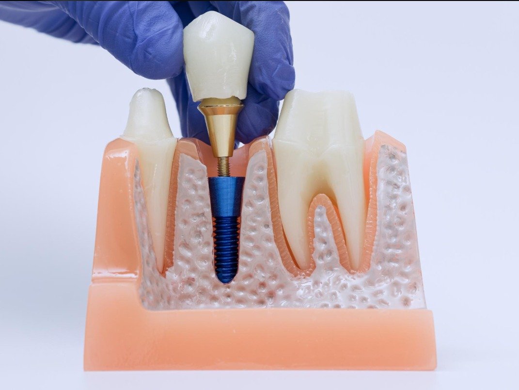 Implant-Supported Dental Crowns