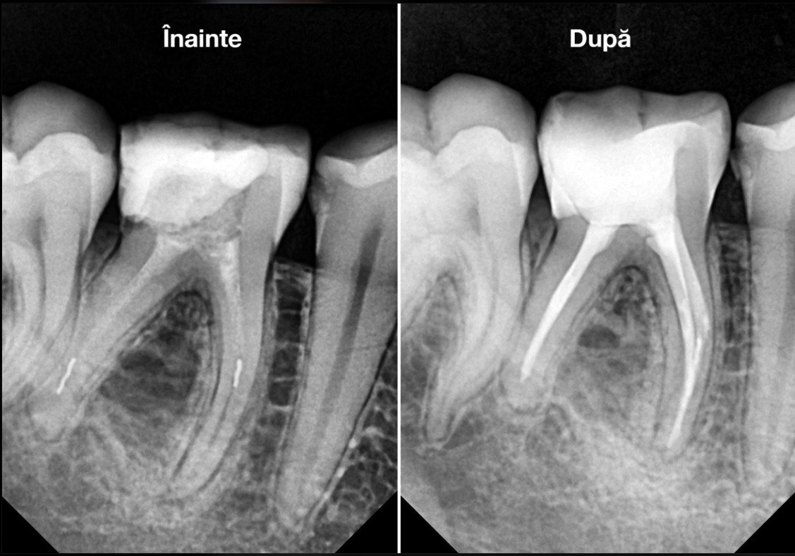 Root Canal Retreatment